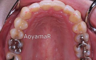 上顎歯列狭窄による上顎両側中切歯の唇側傾斜