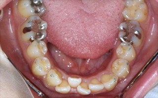 上顎歯列狭窄による上顎両側中切歯の唇側傾斜