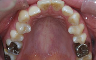 上顎右側近心位による上顎前突、上顎中切歯の唇側傾斜