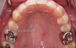 上顎右側近心位による上顎前突、上顎中切歯の唇側傾斜