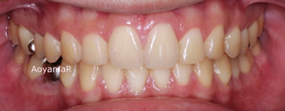 上顎大臼歯近心位による上顎前歯の唇側傾斜