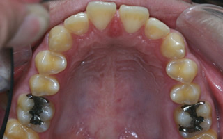 上顎大臼歯近心位による上顎前歯の唇側傾斜