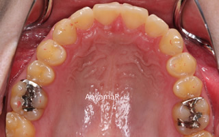 上顎大臼歯近心位による上顎前歯の唇側傾斜