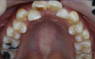 上顎両側近心位を伴う重度の叢生および上顎前歯の突出