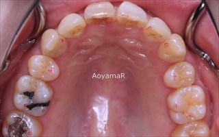 上顎両側近心位を伴う重度の叢生および上顎前歯の突出
