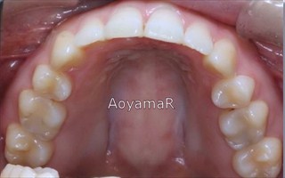 上顎両側近心位を伴う中等度の叢生、上顎中切歯の唇側傾斜