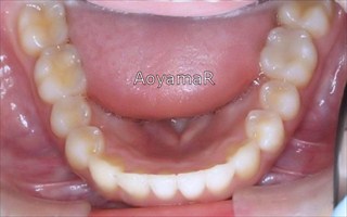 上顎両側近心位を伴う中等度の叢生、上顎中切歯の唇側傾斜