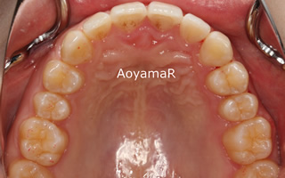 上顎右側近心位による上顎前突、叢生