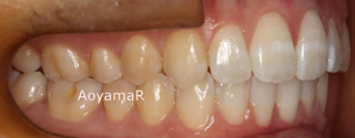 上顎右側近心位による上顎前突、叢生