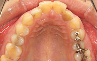 上顎近心位による上顎前突、上顎中切歯の唇側傾斜