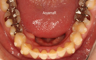 上顎近心位による上顎前突、上顎中切歯の唇側傾斜