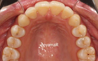 上顎右側近心位による上顎前突、上下顎の叢生