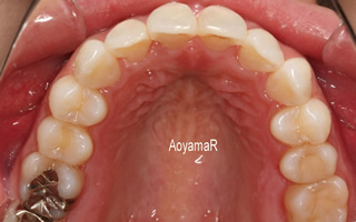 上顎歯列近心位および狭窄による上顎前突、叢生
