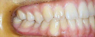 下顎歯列近心位による下顎前歯の叢生および反対咬合