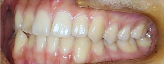 下顎歯列近心位による下顎前歯の叢生および反対咬合