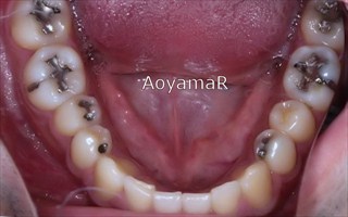 上顎歯列の狭窄、下顎歯列近心位による上下顎前歯の反対咬合
