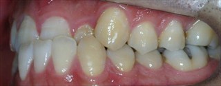 上顎歯列の狭窄、下顎歯列近心位による上下顎前歯の反対咬合