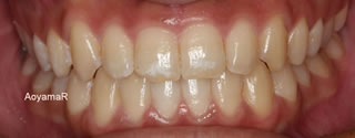 上顎歯列の狭窄による上下顎前歯の反対咬合