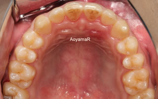 上顎歯列の狭窄による上下顎前歯の反対咬合