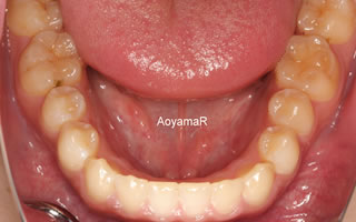 上顎歯列の狭窄による上下顎前歯の反対咬合