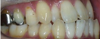 上顎歯列の重度叢生、下顎歯列近心位による上下顎前歯の反対咬合