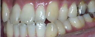 上顎歯列の重度叢生、下顎歯列近心位による上下顎前歯の反対咬合
