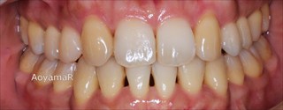 上顎両側側切歯先天欠如による上顎歯列の狭窄