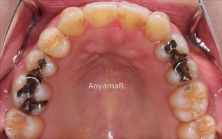 上顎両側側切歯先天欠如による上顎歯列の狭窄