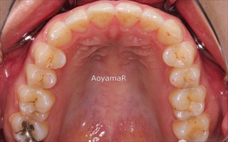上下顎歯列狭窄による反対咬合