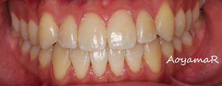 上顎前歯の舌側傾斜による反対咬合