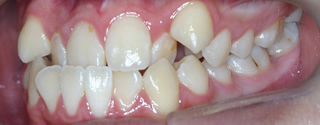 上顎前歯の舌側傾斜による反対咬合