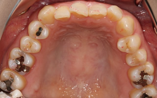 上下顎歯列狭窄による反対咬合