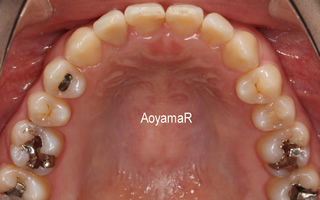 上下顎歯列狭窄による反対咬合