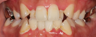 上下歯列の重度叢生、下顎近心位による下顎前歯の反対咬合