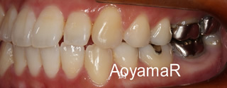 上下歯列の重度叢生、下顎近心位による下顎前歯の反対咬合