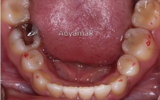 口元の突出、上下顎歯列近心位による上下顎前歯の唇側傾斜