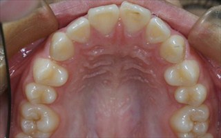 口元の突出、上下顎歯列近心位による上下顎前歯の唇側傾斜