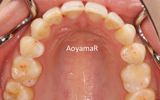 口元の突出、重度叢生を伴う上下顎歯列の近心位