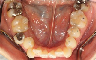 口元の突出、重度叢生を伴う上下顎歯列の近心位