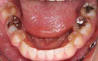 口元の突出、重度叢生を伴う下顎歯列の近心位