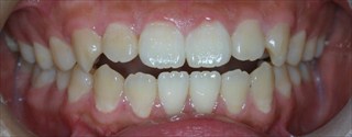 口元の突出、開咬を伴う上下顎歯列の近心位