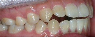 口元の突出、開咬を伴う上下顎歯列の近心位