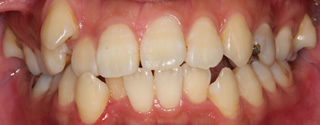 上下右側犬歯低位唇側転位を伴う上下顎歯列重度の叢生、軽度の開咬