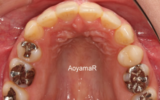 上下右側犬歯低位唇側転位を伴う上下顎歯列重度の叢生、軽度の開咬