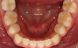 上下右側犬歯低位唇側転位を伴う上下顎歯列重度の叢生、軽度の開咬