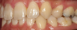 上下右側犬歯低位唇側転位を伴う上下顎歯列重度の叢生、軽度の開咬