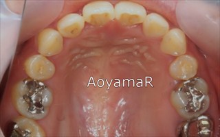 上顎歯列近心位による開咬、上顎前歯の唇側傾斜