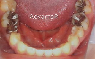上顎歯列近心位による開咬、上顎前歯の唇側傾斜
