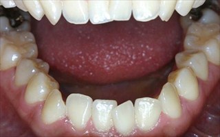 下顎歯列の近心位、重度の叢生、上下顎歯列の狭窄による開咬