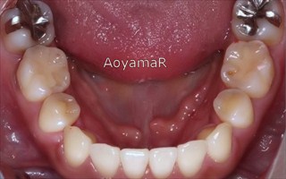 下顎歯列の近心位、重度の叢生、上下顎歯列の狭窄による開咬